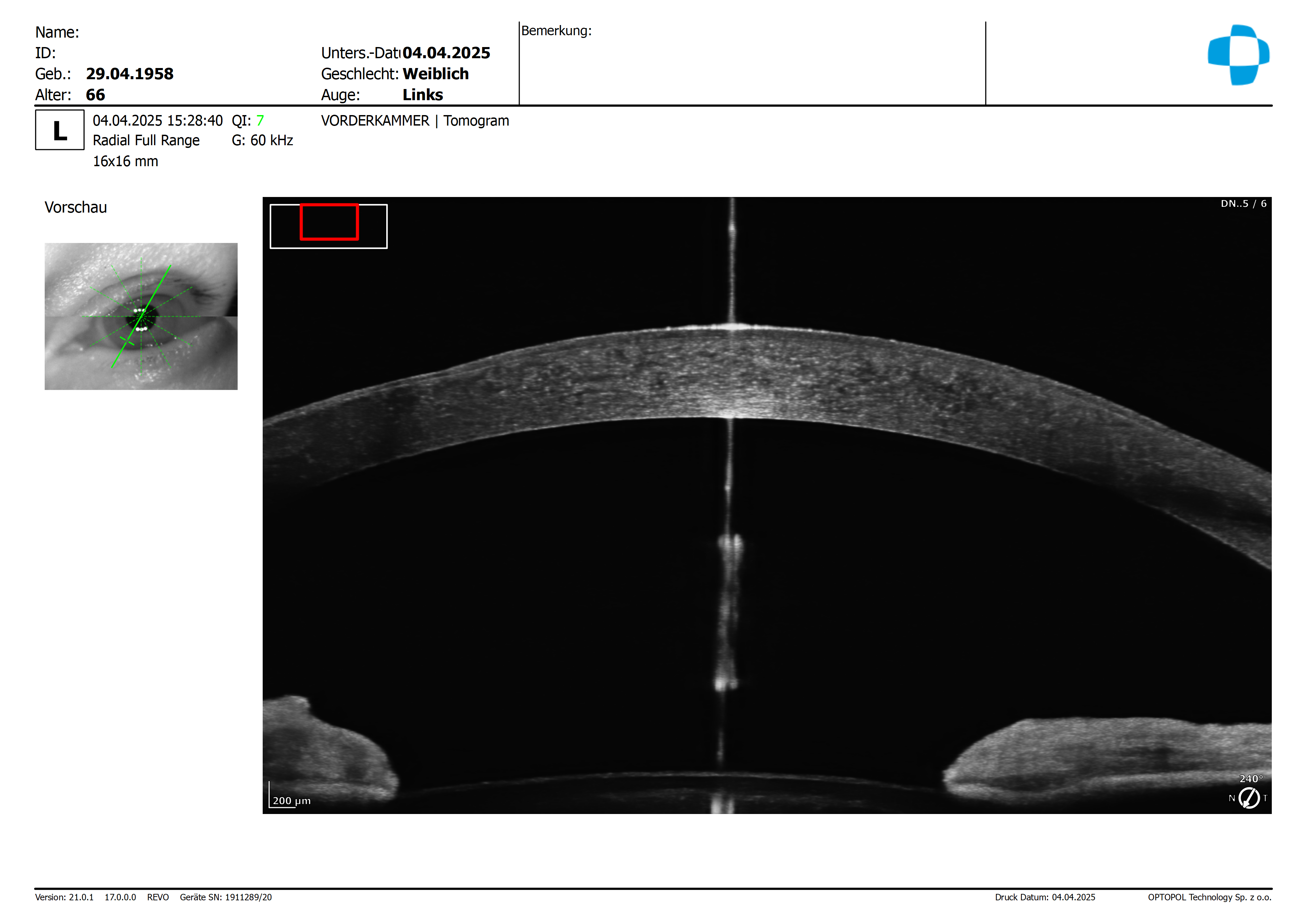 20250404_152840_Vorderkammer_Radial_Full_Range_L_Tomogram_16mm_8192x62.png