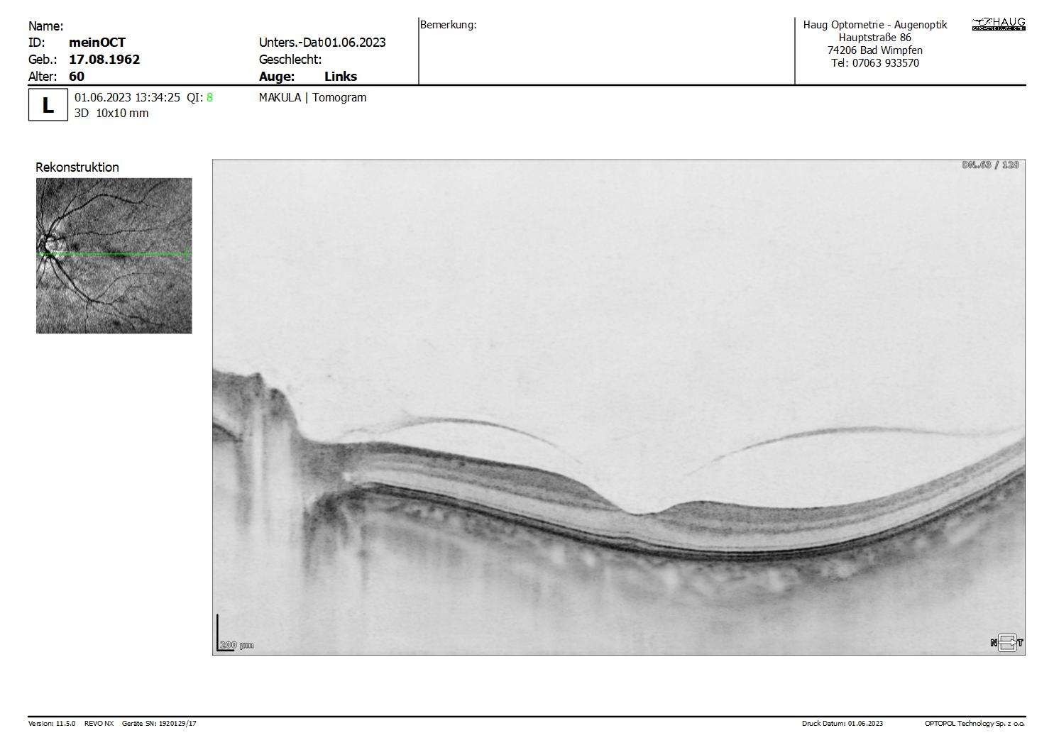 meinOCT___20230601_133425_Makula_3D_L_Tomogram_10mm_1024x128_REPORT.jpg