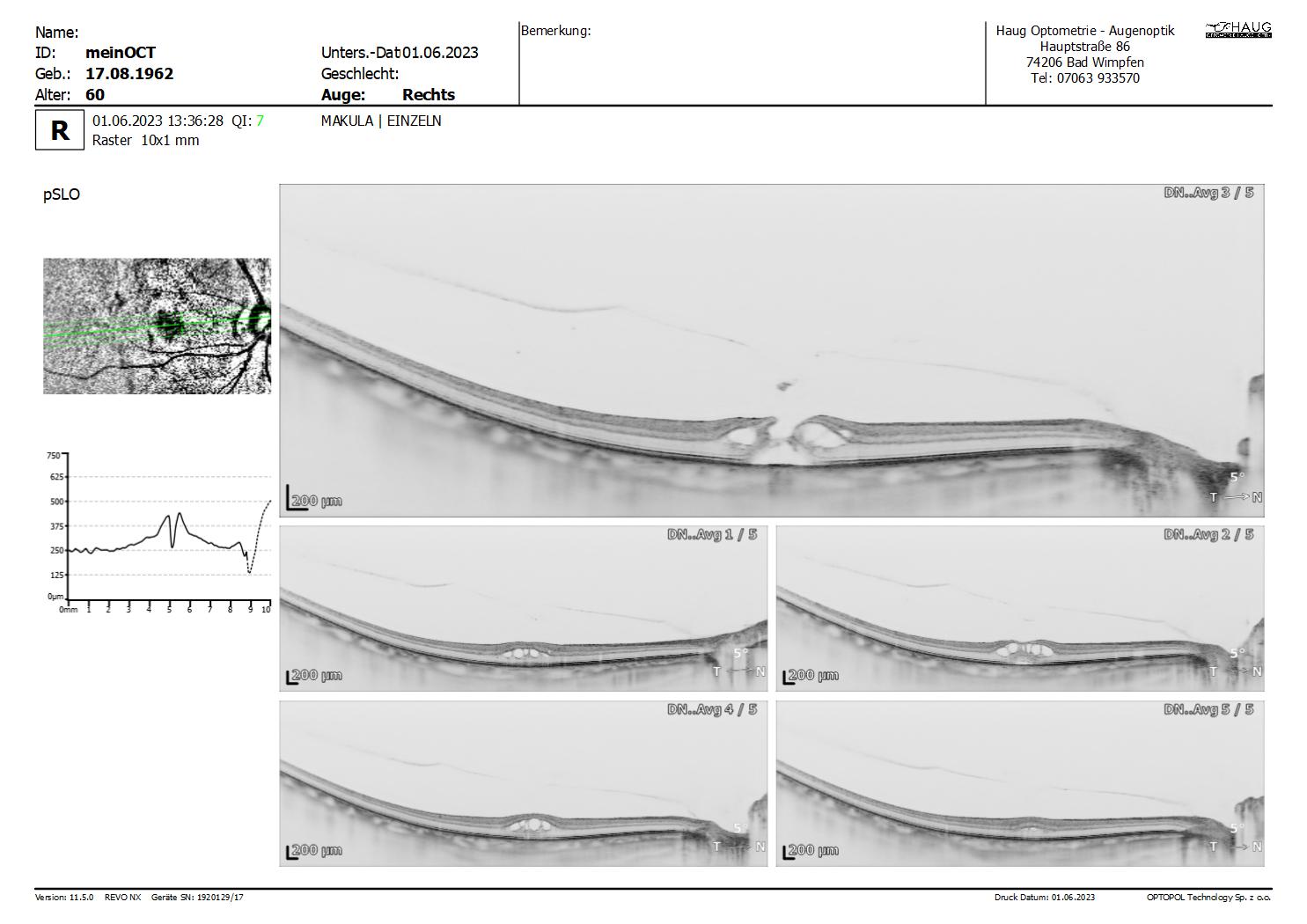 meinOCT___20230601_133628_Makula_Raster_R_EINZELN_10mm_1280x5x20_REPORT.jpg
