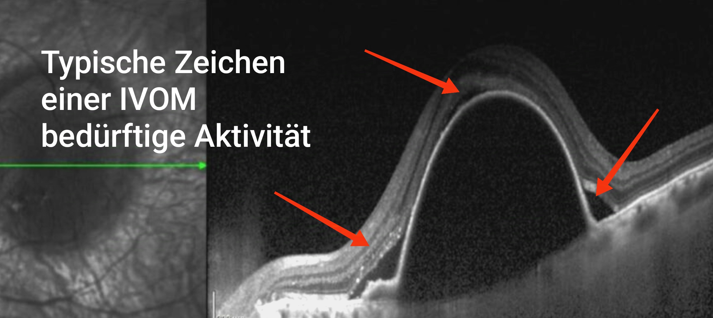 Kriterien für IVOM Therapie 